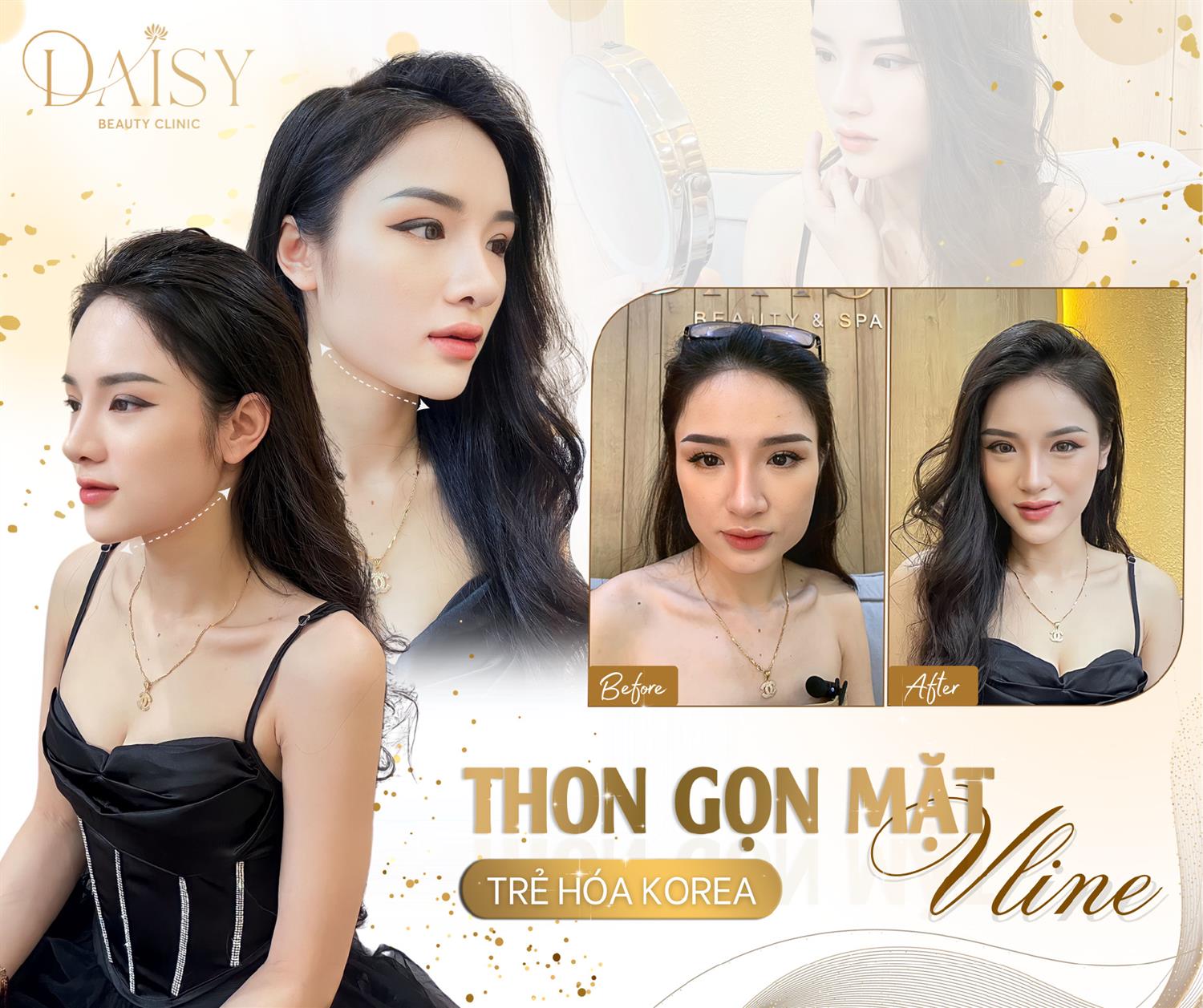 THON GỌN MẶT VLINE - FEEDBACK KHÁCH HÀNG 